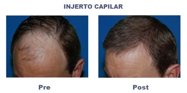 precio injerto capilar entradas trasplante capilar cl 237 nicas mato ansorena precio injerto capilar entradas trasplante capilar cl 237 nicas mato ansorena