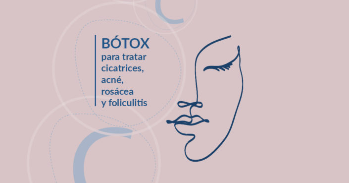 BLOG-MATO-ANSORENA-ARTE-BOTOX Bótox para tratar acné, rosácea, cicatrices y foliculitis.