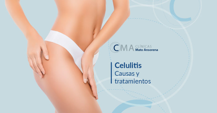 BLOG-celulitis-mato-ansorena celulitis