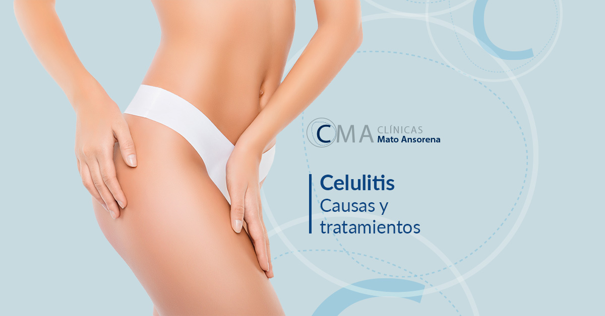 celulitis