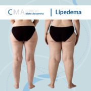 lipedema