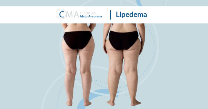 BLOG-lipedema lipedema