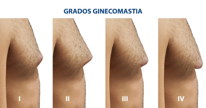 GradosGinecomastiaClinicasMatoAnsorena