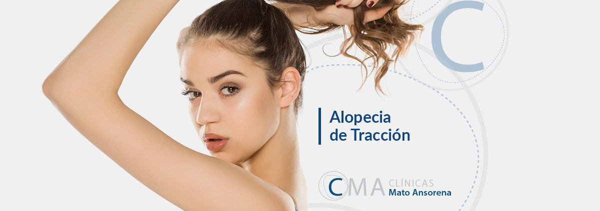 alopecia por tracción