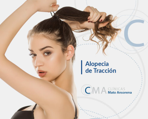 alopecia por tracción