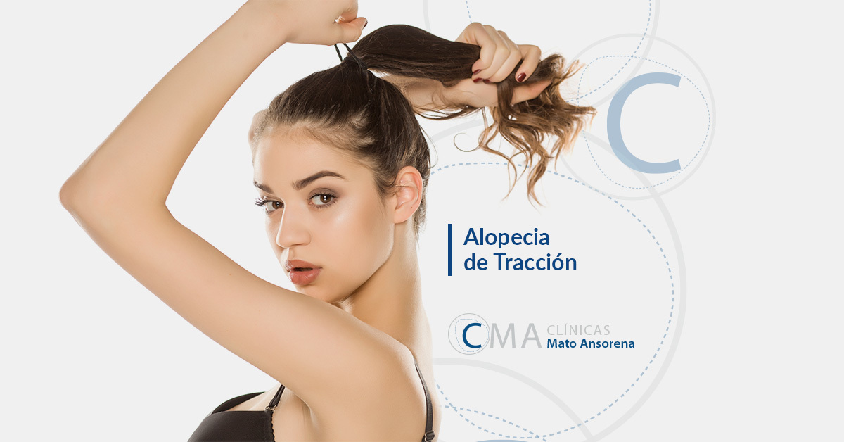 alopecia por tracción