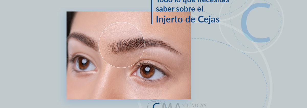 injerto de cejas