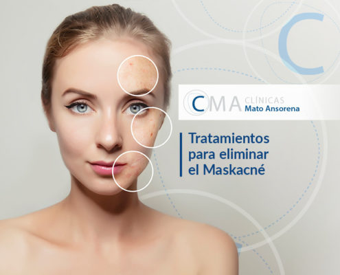 Maskacné: por qué aparece y cómo eliminarlo