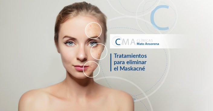 MATO-ANSORENA-BLOG-12NOV Maskacné: por qué aparece y cómo eliminarlo