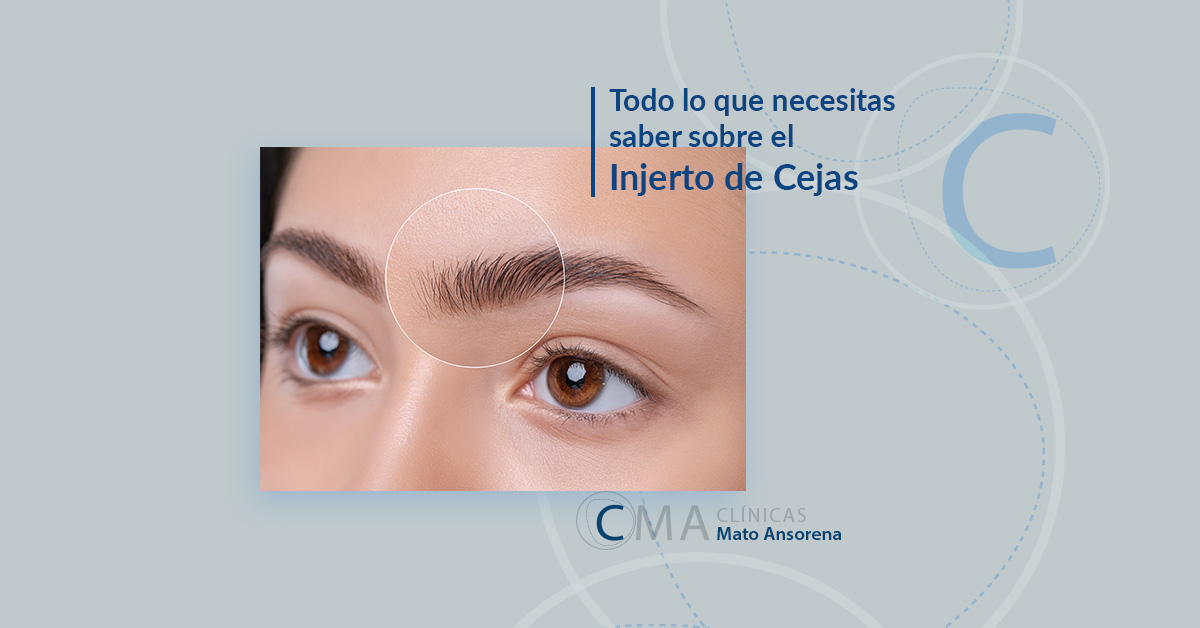 injerto de cejas