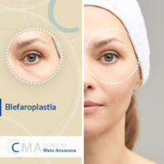 blefaroplastia técnica poco invasiva