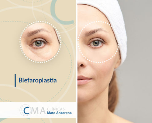 blefaroplastia técnica poco invasiva