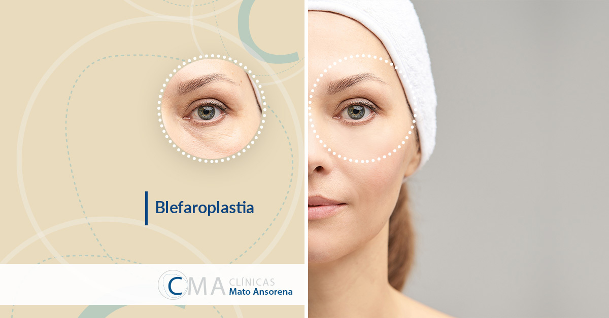 blefaroplastia técnica poco invasiva