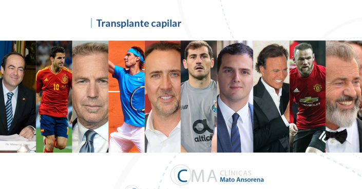PLANTILLA-BLOG famosos trasplante capilar