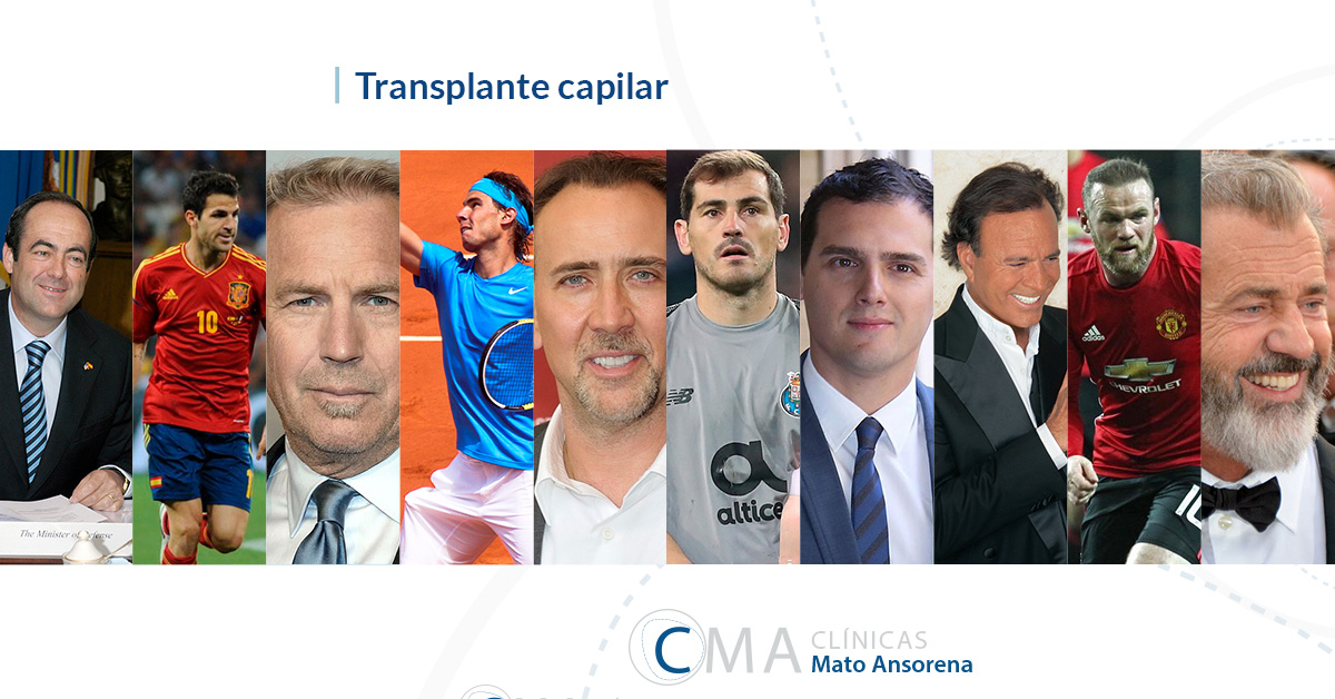 famosos trasplante capilar