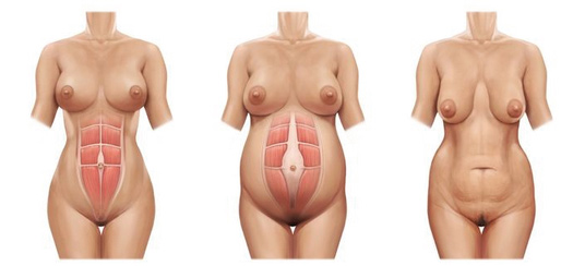 Abdominoplastia tras Embarazo