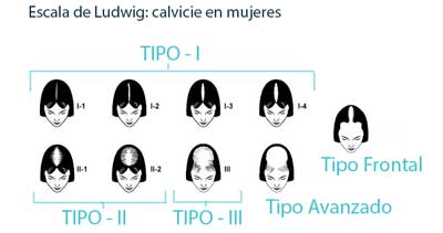 alopecia-femenina-escala-ludwig