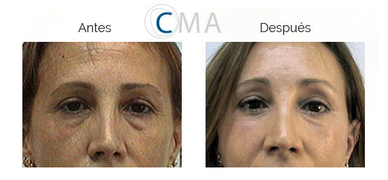 Ojos de mujer antes y después de blefaroplastia