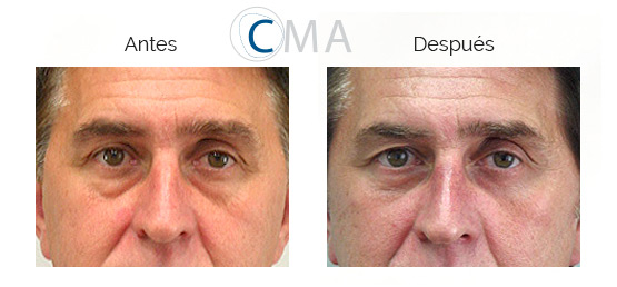 Ojos de hombre antes y después de blefaroplastia