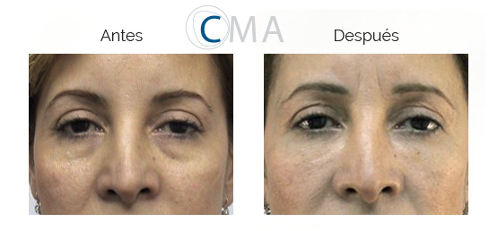 Ojos de mujer antes y después de blefaroplastia