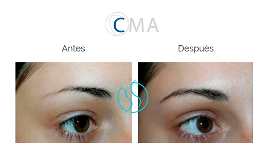 antes-y-despues-injerto-cejas