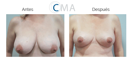 antes-y-despues-mastectomia
