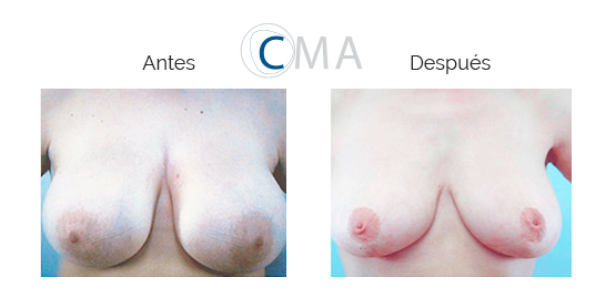 Antes y después de los senos de una mujer tras cirugía de reducción de pecho