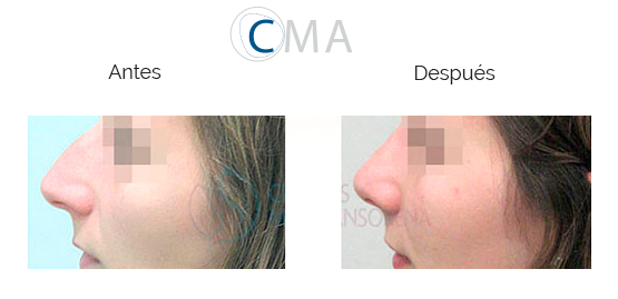 Antes y después de la nariz de una mujer al realizar rinoplastia