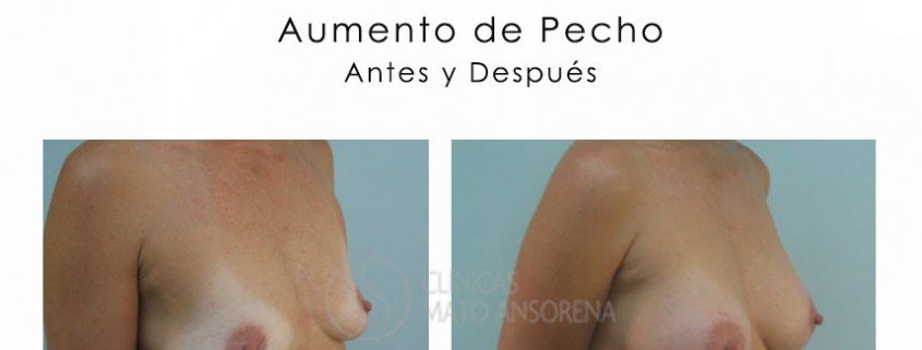 Aumento de Pecho - Aumento de Senos - Antes y Después