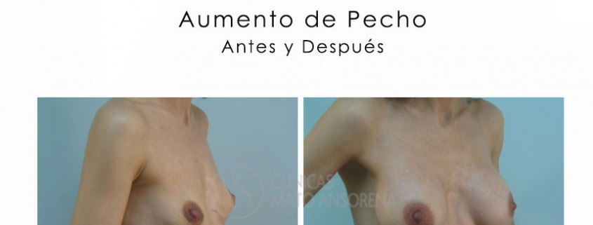 Aumento de Pecho - Aumento de Senos - Antes y Después