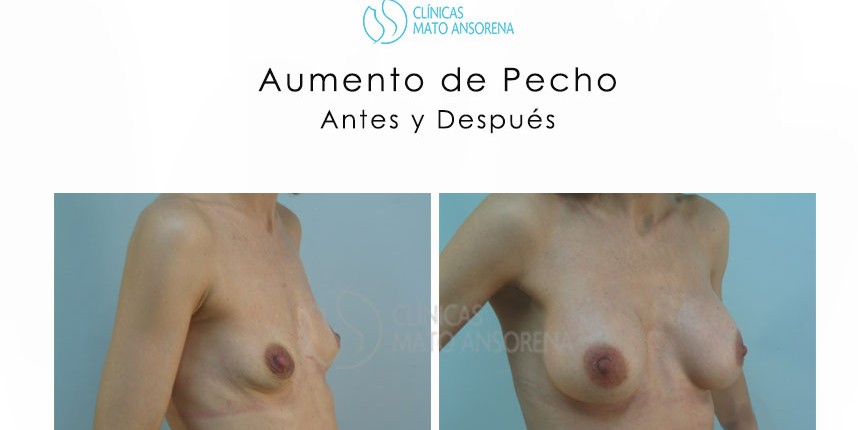 Aumento de Pecho - Aumento de Senos - Antes y Después