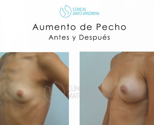 Aumento de Pecho - Aumento de Senos - Antes y Después