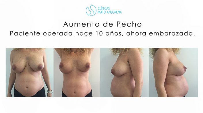 aumento-de-pecho-embarazo