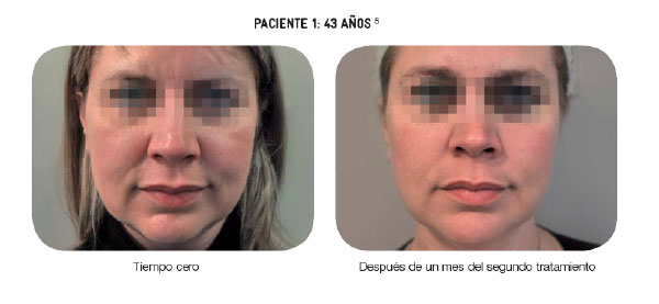 Bioremodelacion Facial Profhilo