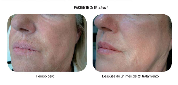 Bioremodelacion Facial Profhilo