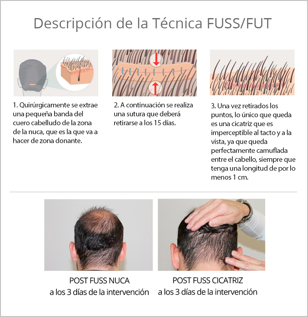 descripcion-trasplante-capilar-tecnica-fuss-fut