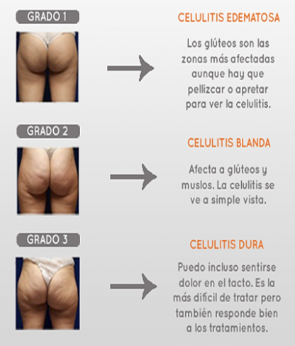 celulitis qué es