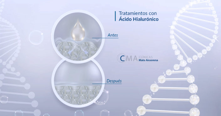 martes-13-blog-tratamientos-acido-hialuronico ácido hialurónico