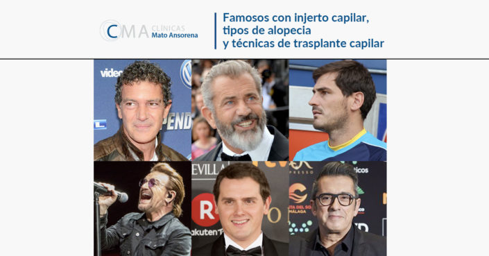 mato-iblog-24sept amosos con injerto capilar, tipos de alopecia y técnicas de trasplante capilar