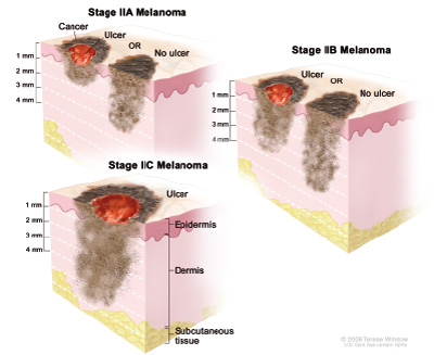 Melanoma - Cancer de piel