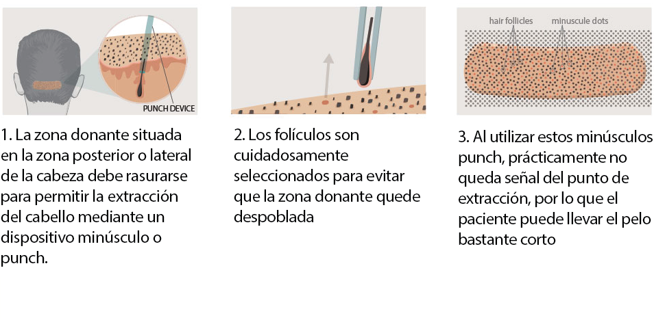 Trasplante de Cejas