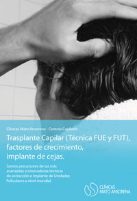 Trasplante de pelo - Madrid, Marbella, Sevilla, Huelva