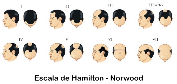 Trasplante de pelo - Madrid, Marbella, Sevilla, Huelva